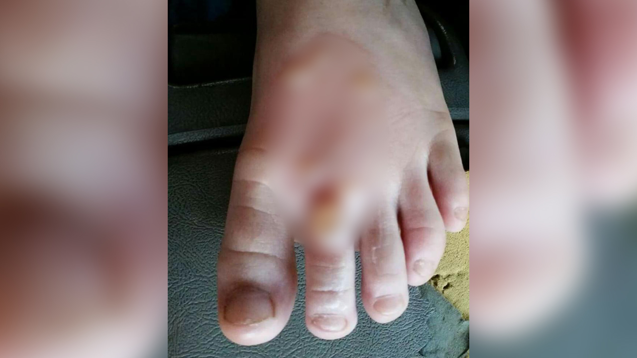 7yearold burned after dropping scalding mashed potatoes on foot at